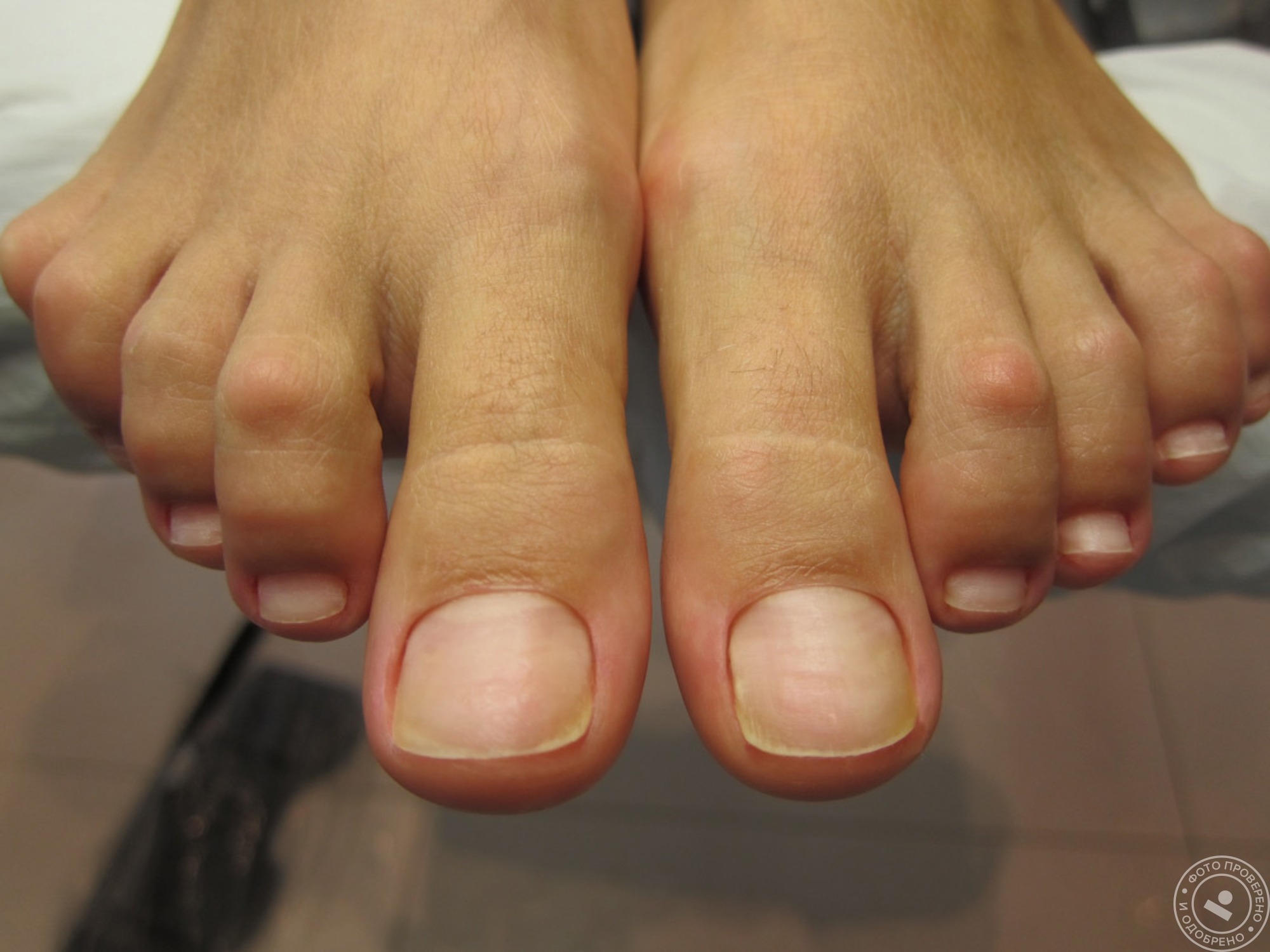 Педикюр до и после. Мужской педикюр. Здоровые ногти на ногах.
