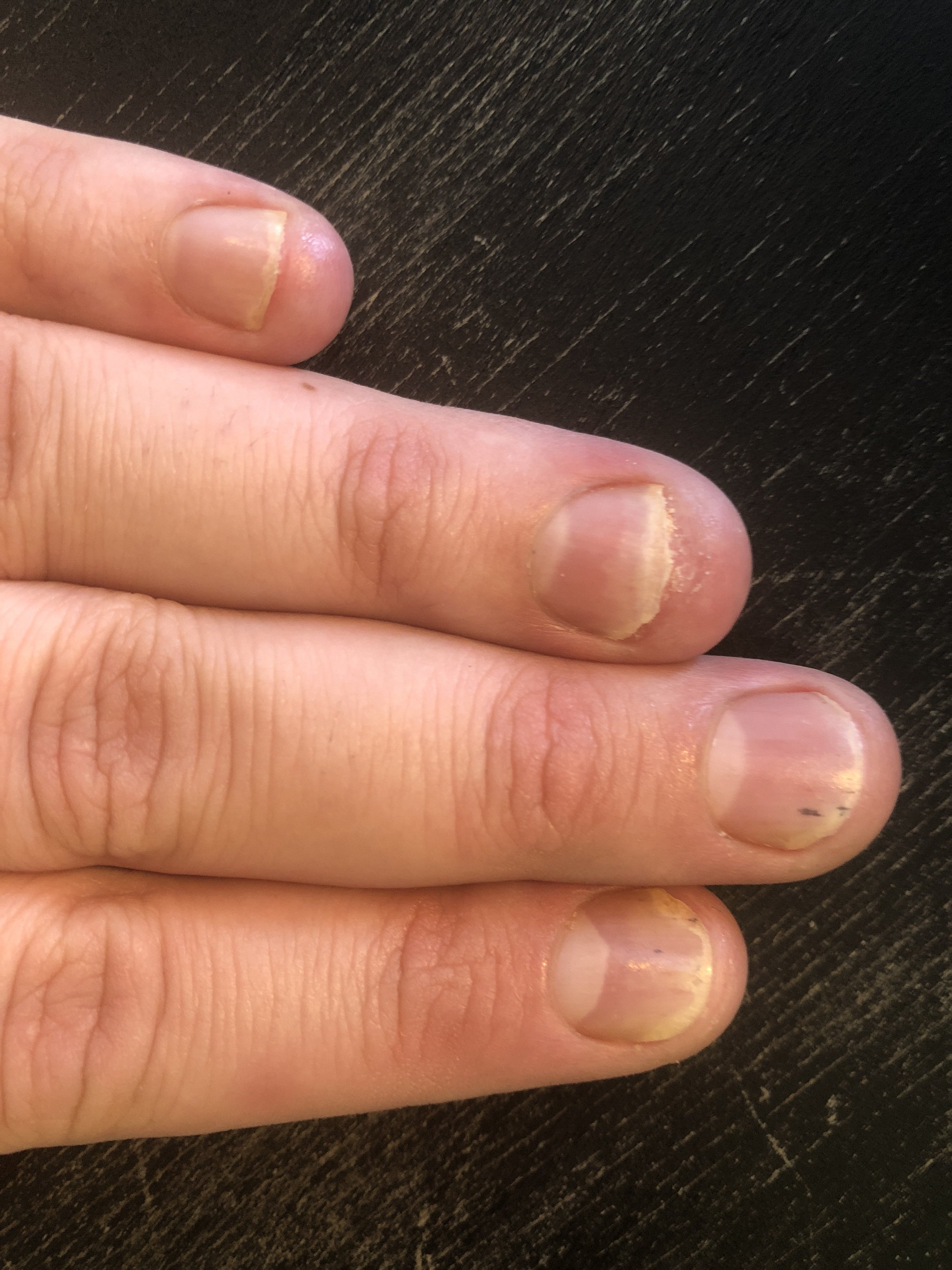О чем сигнализируют черные полоски на ногтях? Лечение и профилактика проблемы