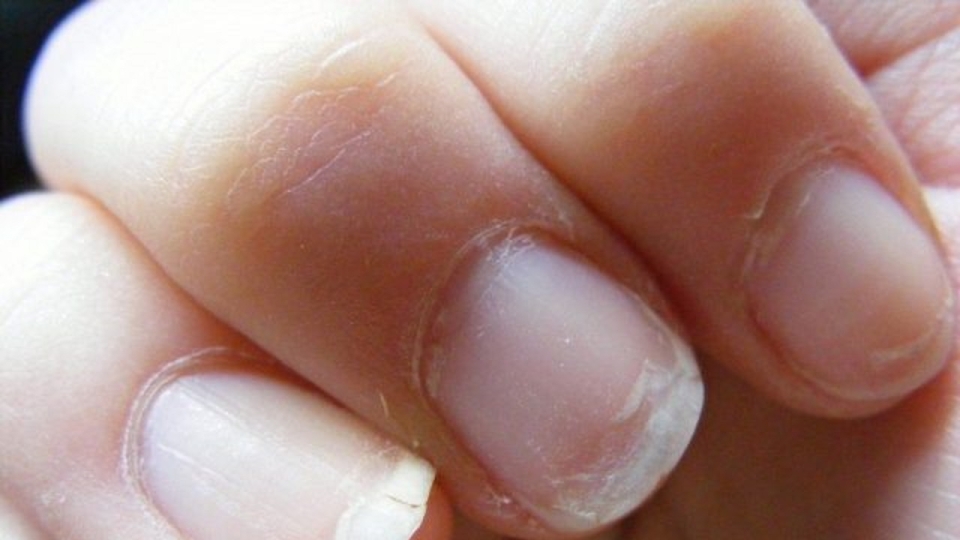 Микотическая лейконихия