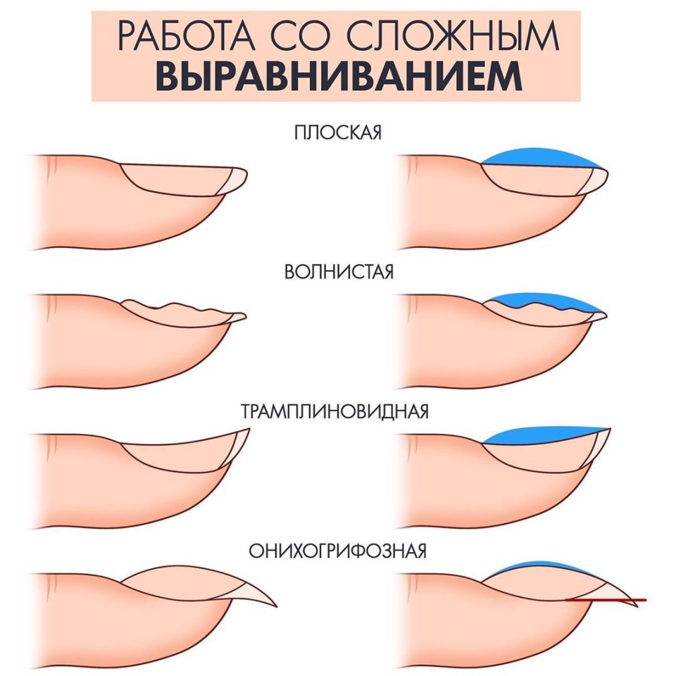 Выравнивание ногтевой пластины схема