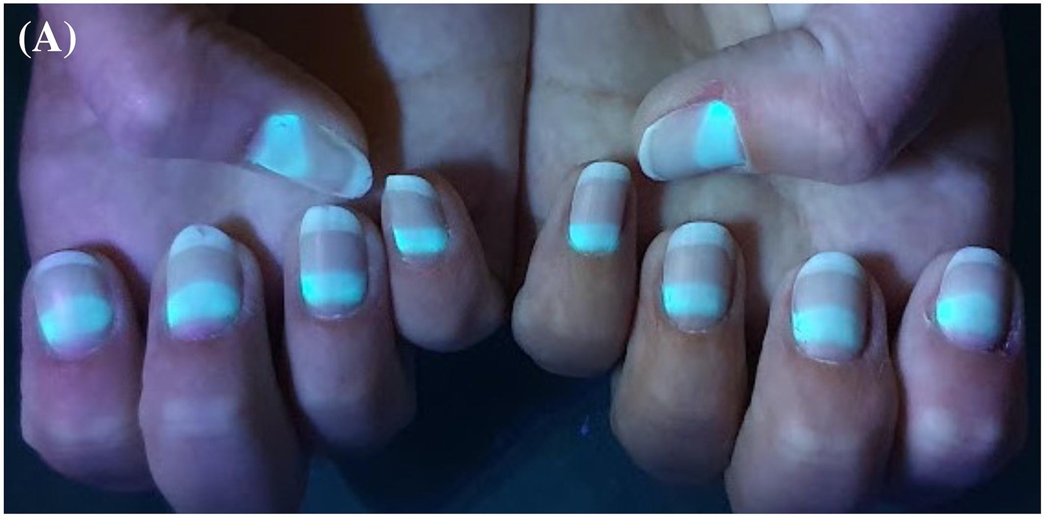 Ногти светятся в ультрафиолете после коронавируса