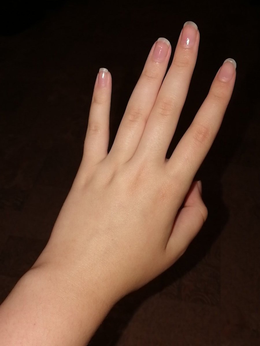Фото пальца без ногтя на руке