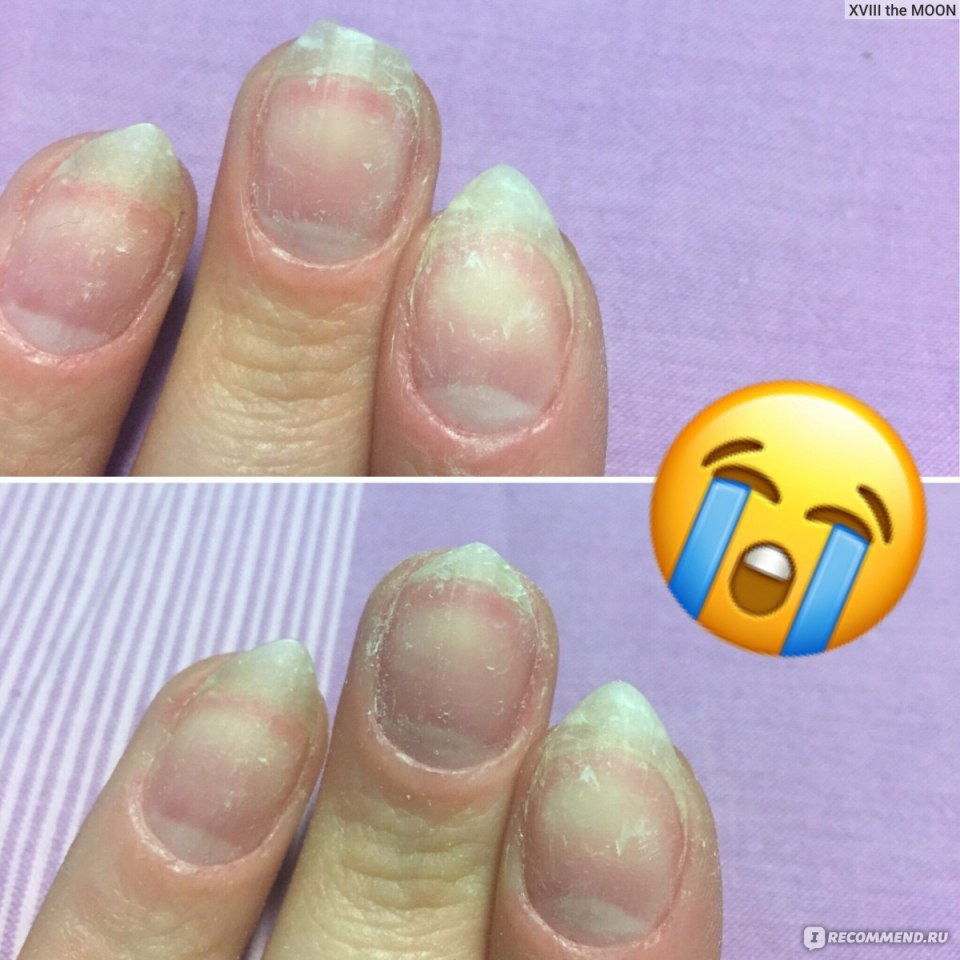 Отрастание кожи под ногтями