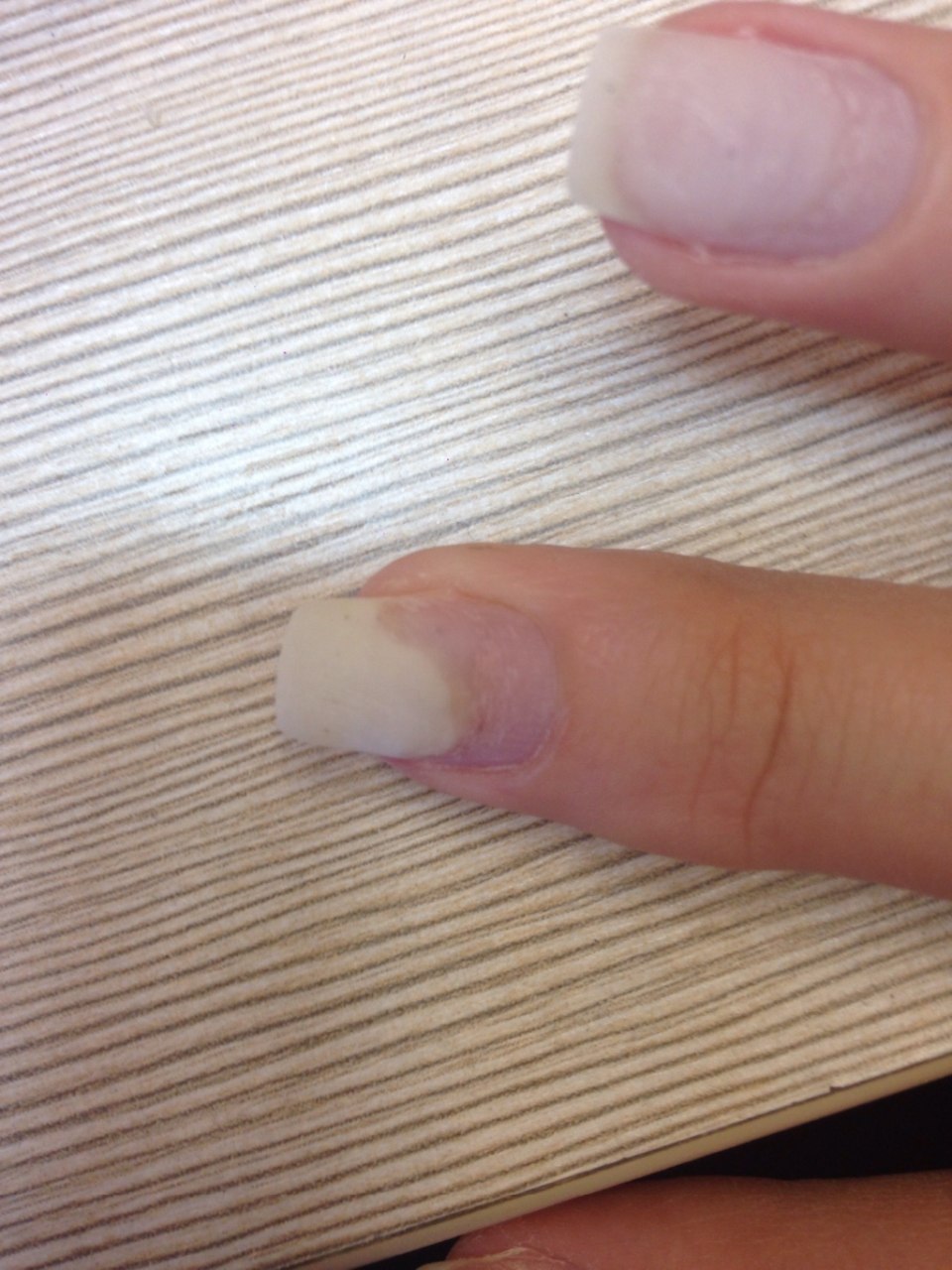 Пропилы фрезой у кутикулы