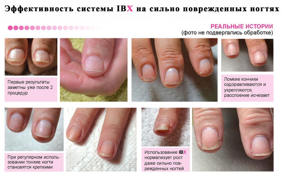 Восстановление поврежденного ногтя