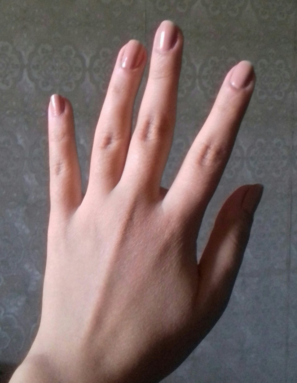 Клинодактилия мизинцев