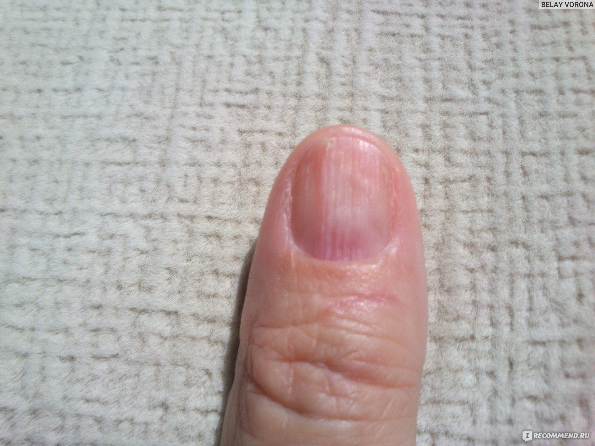 Полоски на ногтях причины вертикальные у женщин. Продольная меланонихия. Ребристые ногти на руках причины.