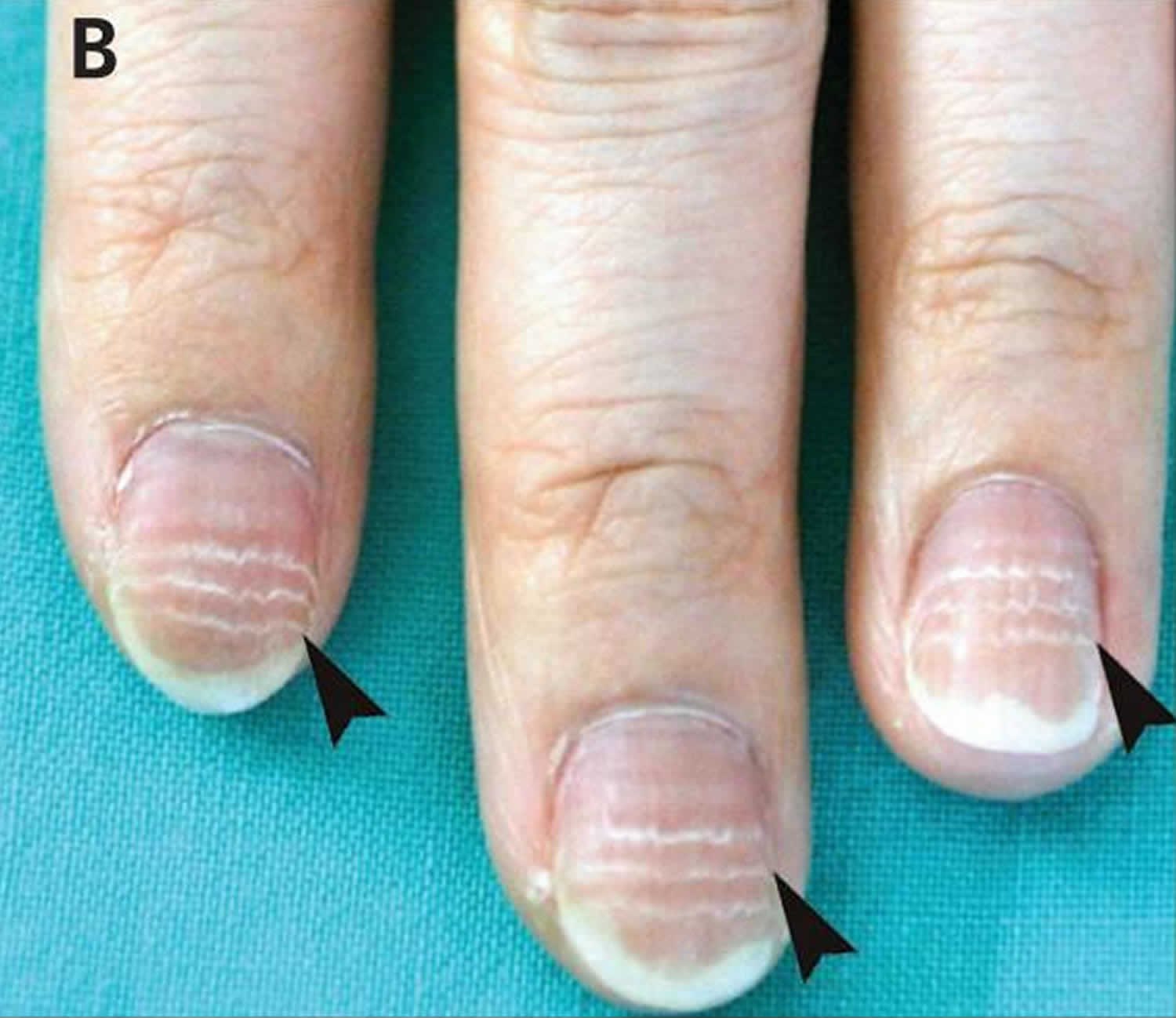Полосы на ногтях что значит. Онихорексис, ониходистрофия. Ногти поперечные борозды бо (линии бо-Рейля). Ониходистрофия (дистрофия ногтей). Ониходистрофия поперечные борозды.
