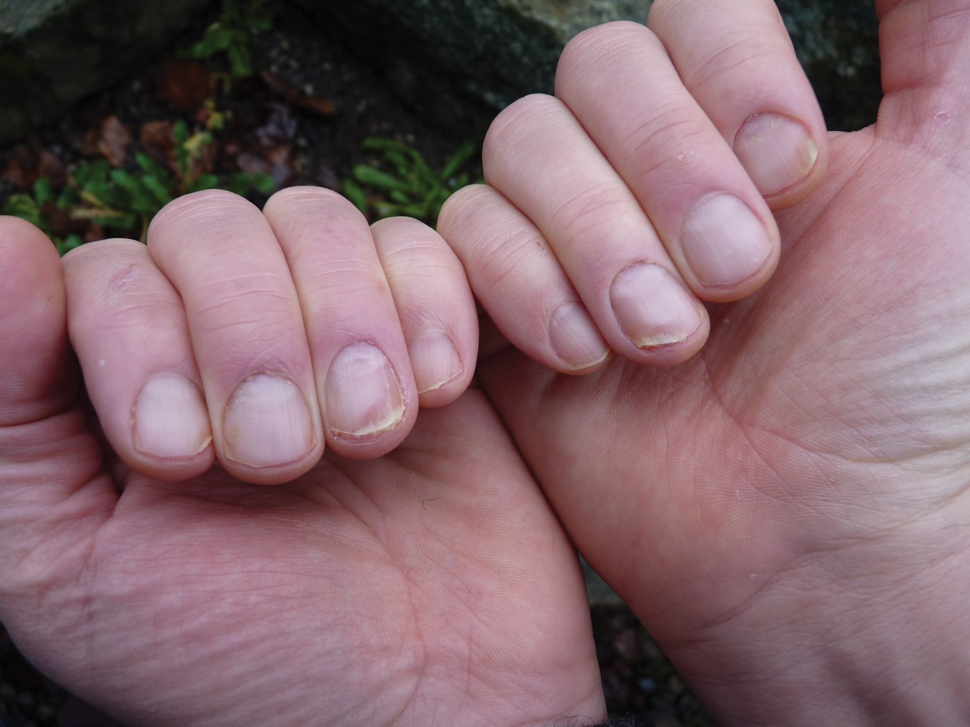 Псориазные ногти на руках