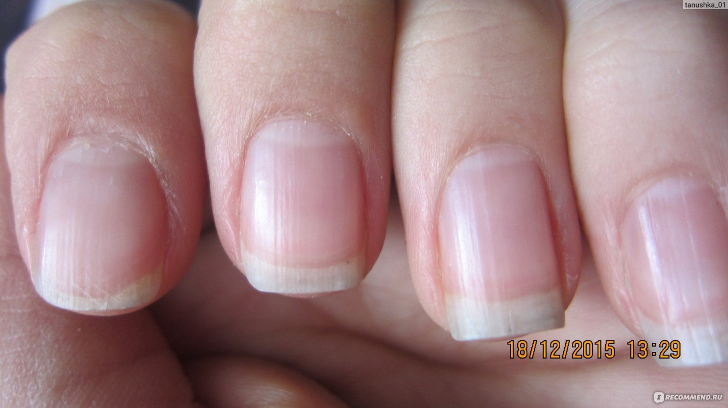 Полоски на ногтях причины вертикальные у женщин. Поперечные борозды бо Рейля. Поперечные полоски на ногтях. Продольные полоски на ногтях.