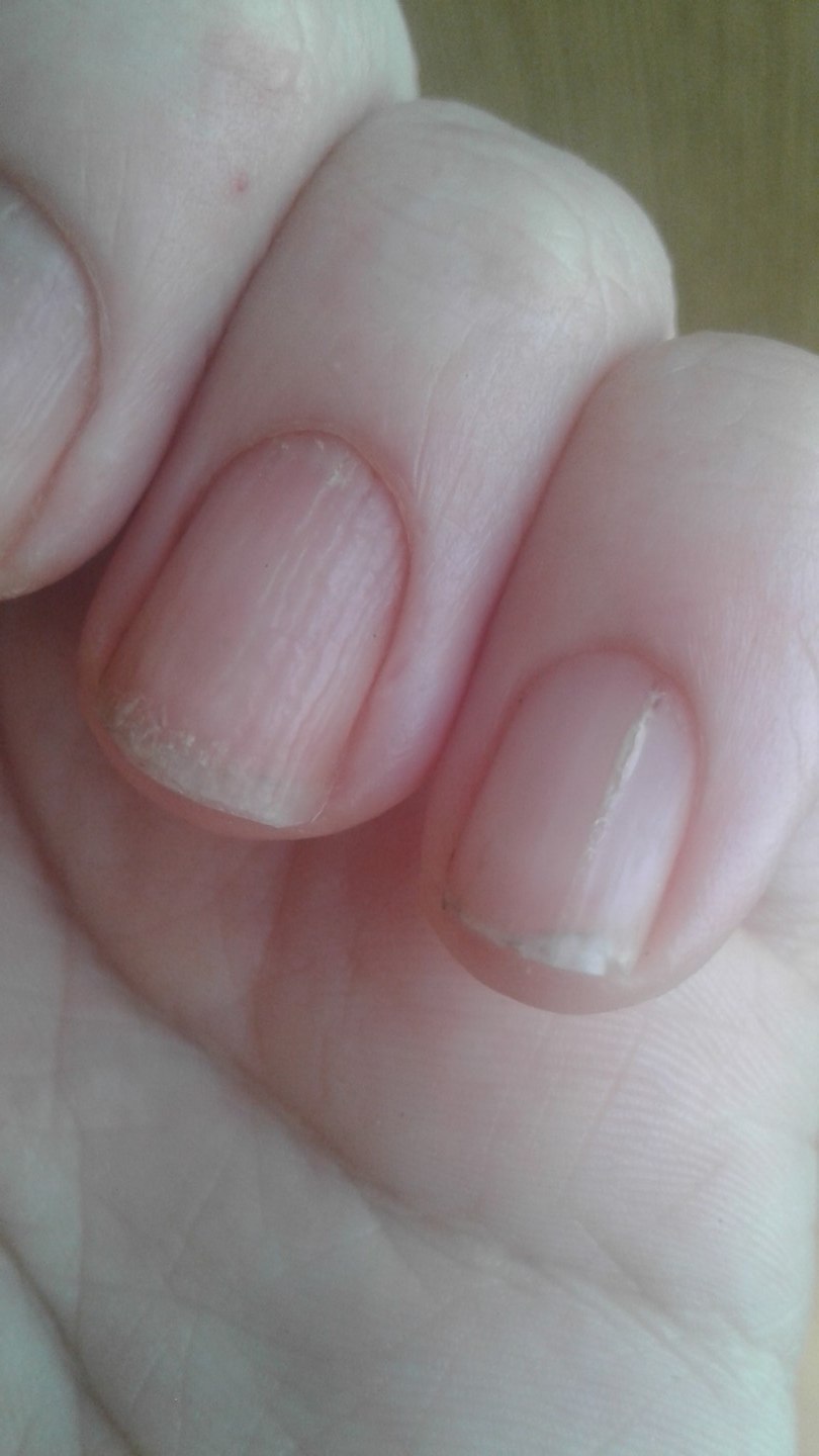 Лейконихия (белые пятнышки)