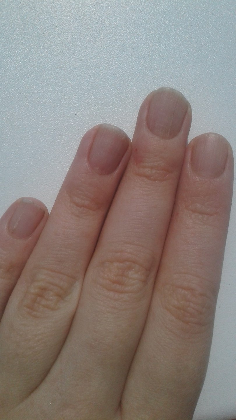 Лейконихия (белые пятнышки)