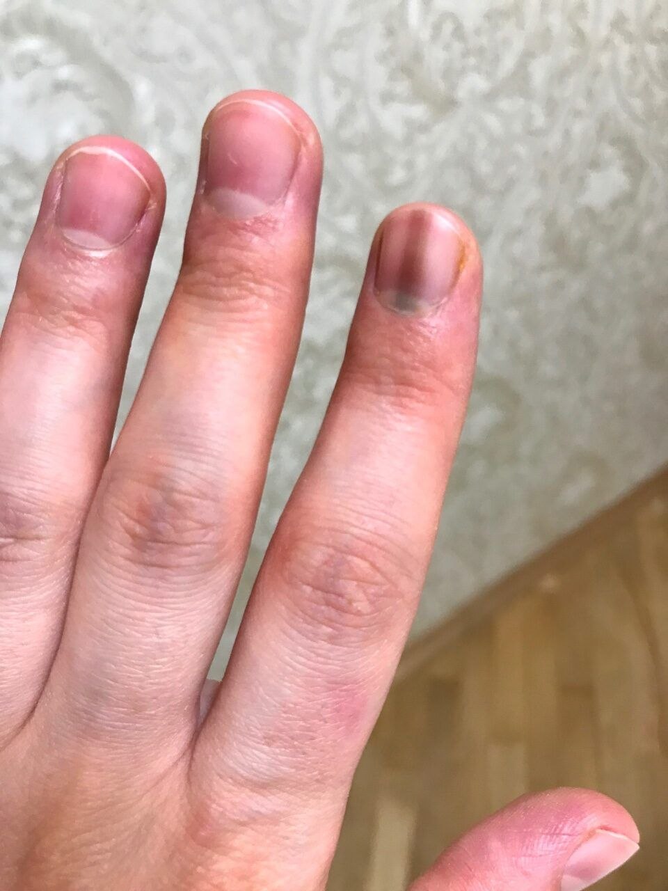 Поперечные борозды на ногтях