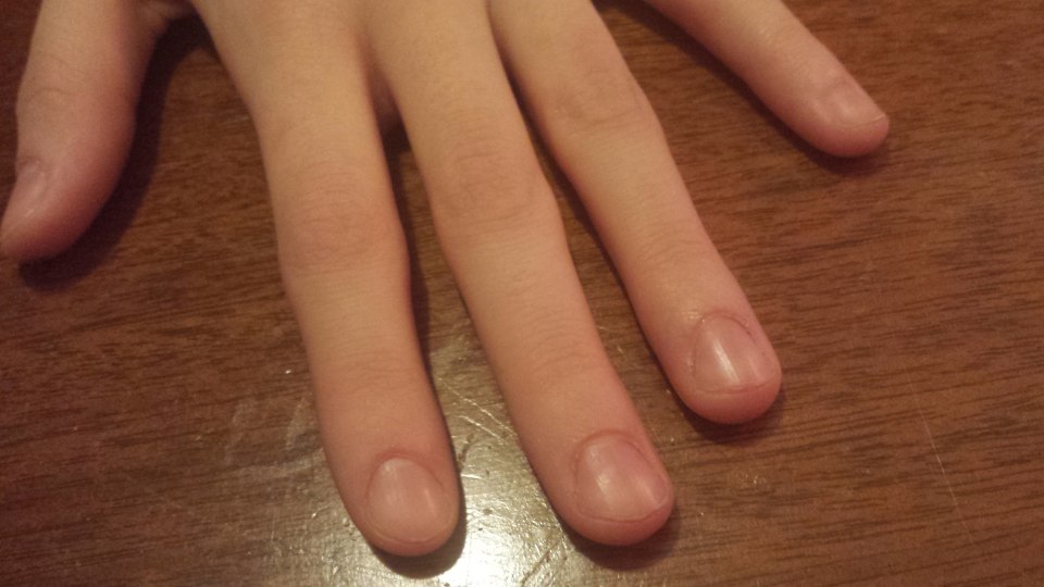 Обгрызанные ногти детские