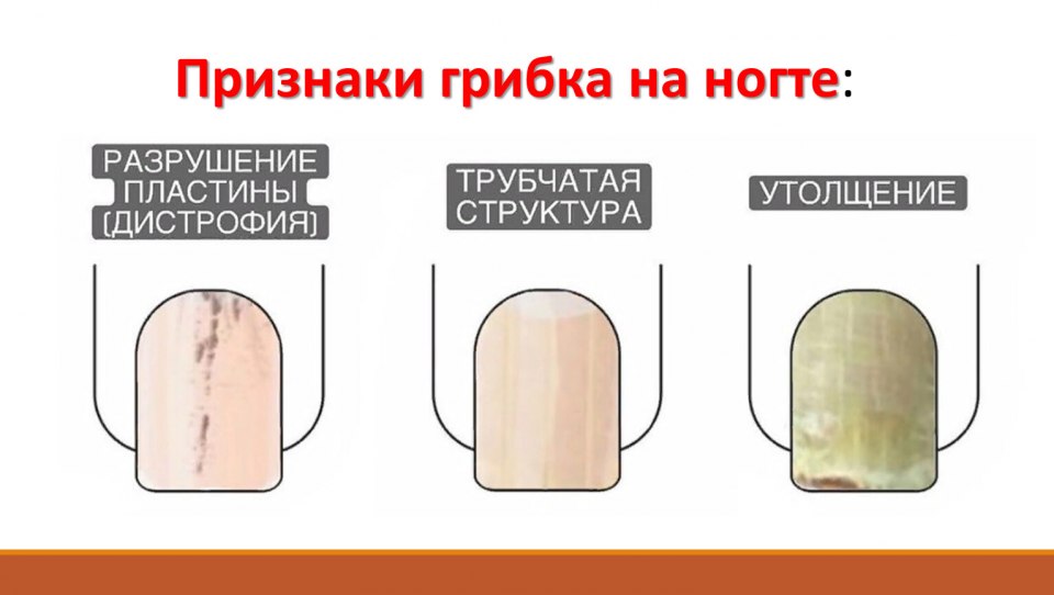 Заболевания ногтей таблица
