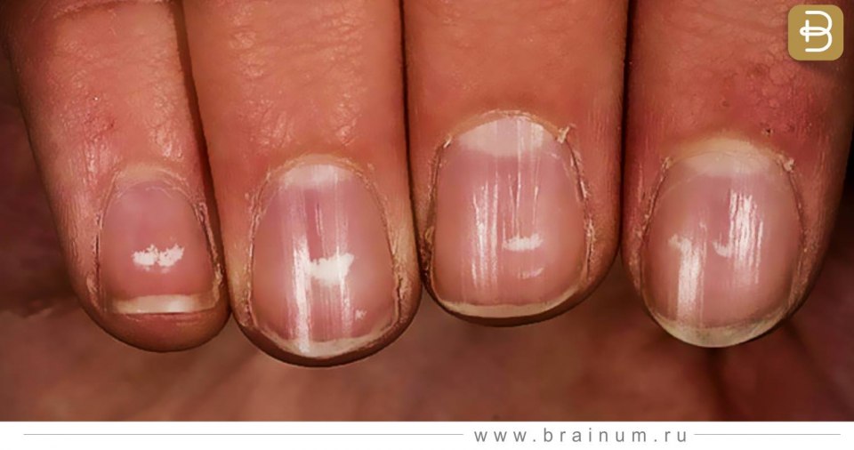 Лейконихия продольная