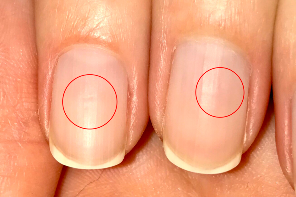 Продольные полоски на ногтях