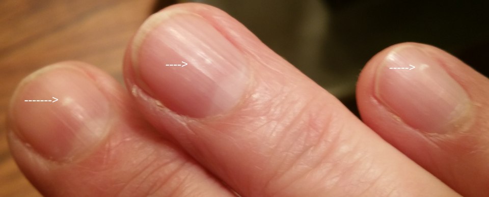 Продольная меланонихия