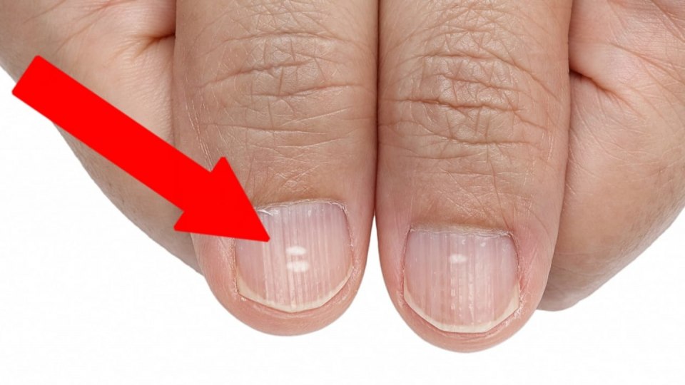 Лейконихия (белые пятнышки)