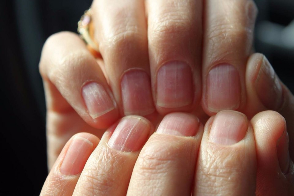 Поперечные борозды бо-Рейли