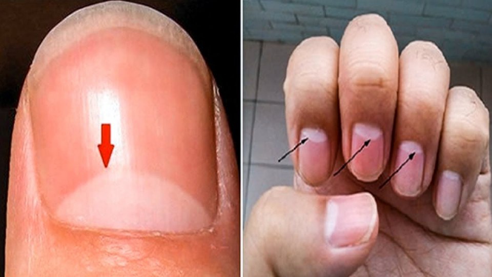 Лунки на ногтях