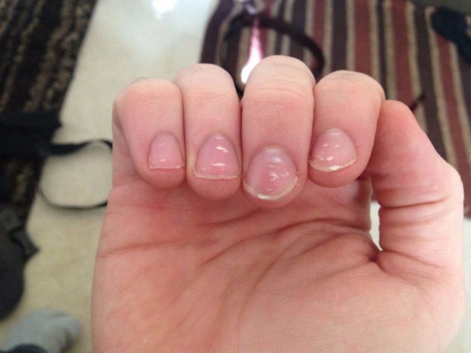 Лейконихия белые пятна на ногтях