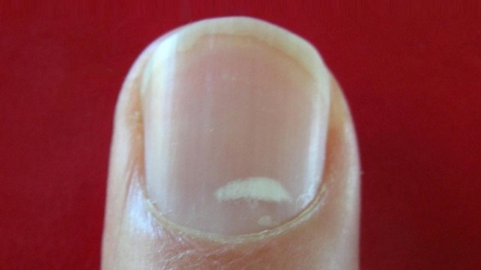 Поперечные борозды на ногтях