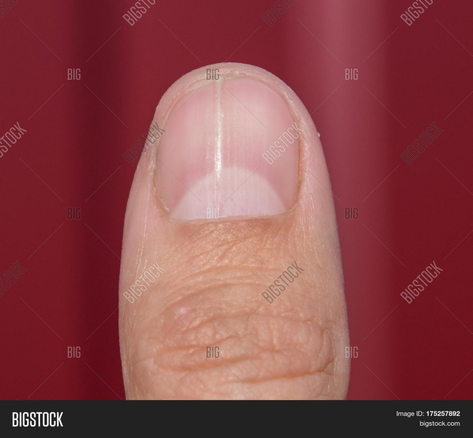 Полоса на ногтевой пластине