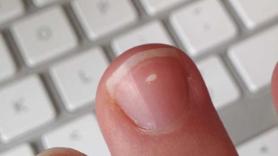 Микотическая лейконихия