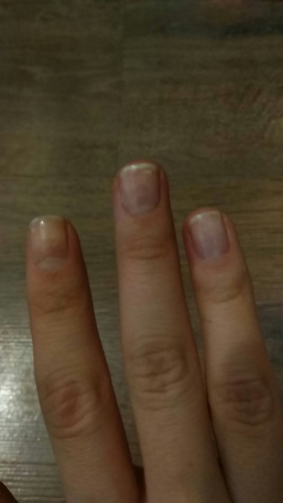 Продольные полосы на ногтях