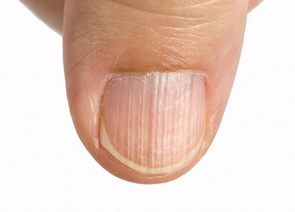 Поперечные борозды бо (линии бо-Рейля)