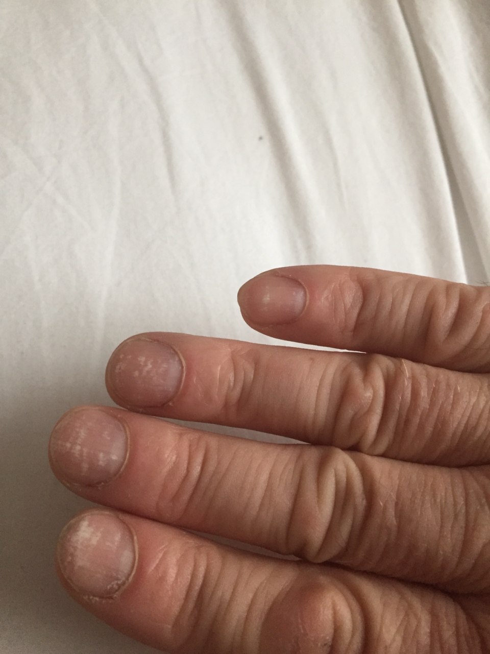 Поперечная исчерченность ногтей