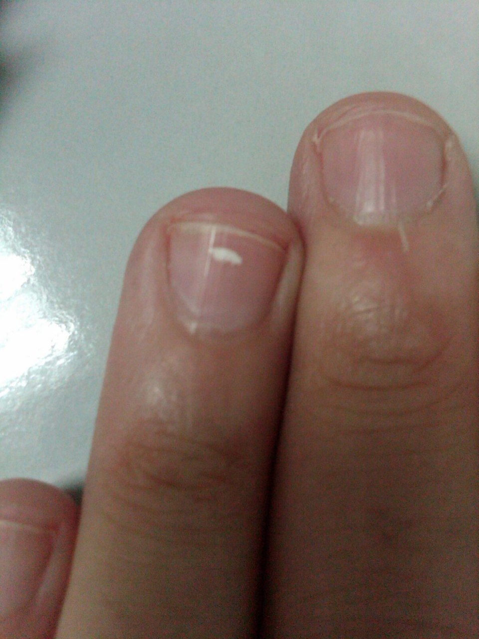 Выявление болезни по ногтям