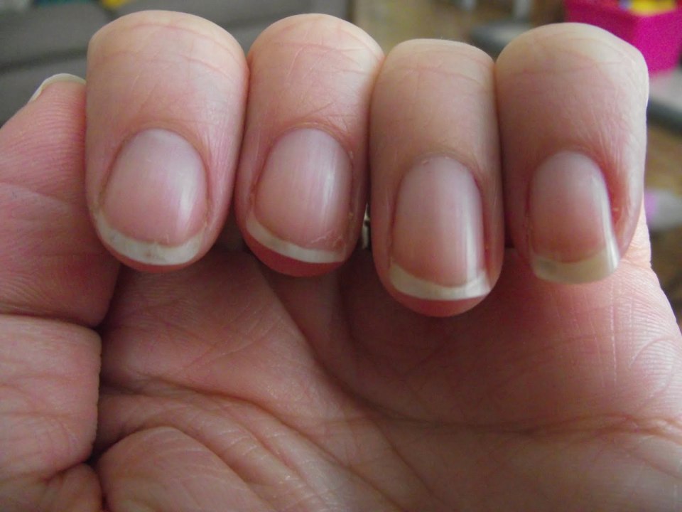 Микотическая лейконихия