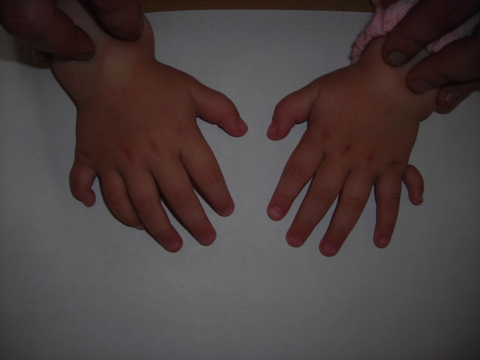 Люди с шестью пальцами на руке