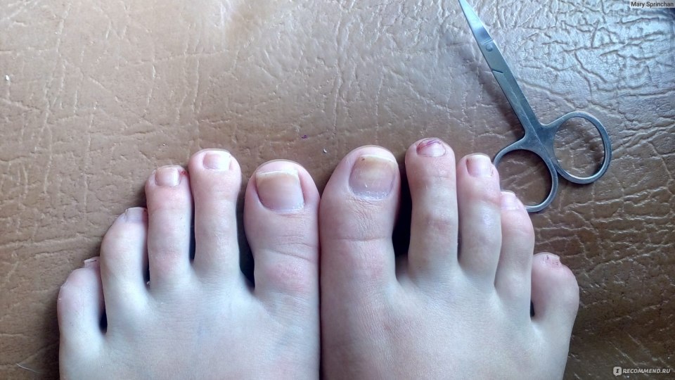 Подпиливание ногтей на ногах