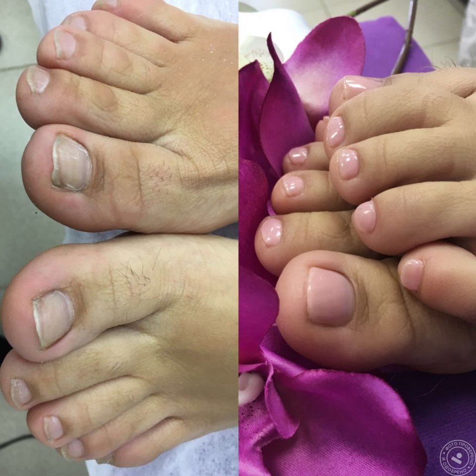 Педикюр наращивание