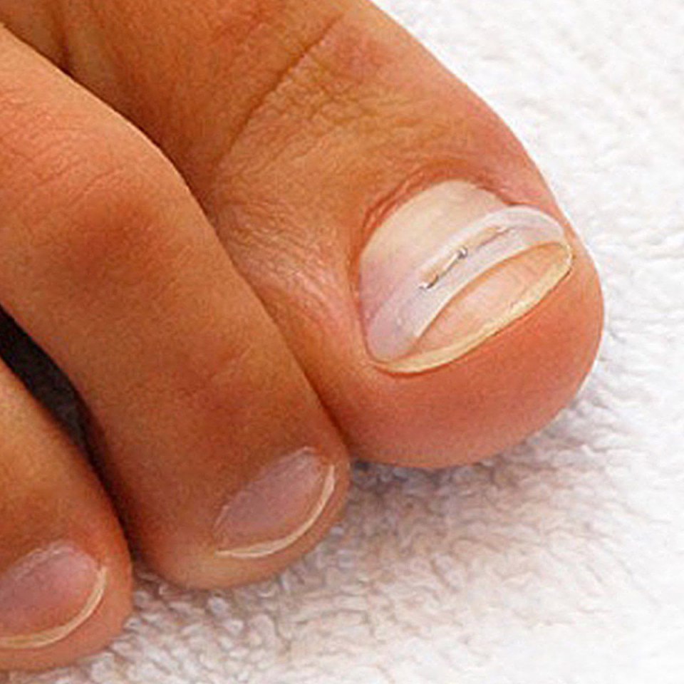 Коррекция вросшего ногтя пластинами