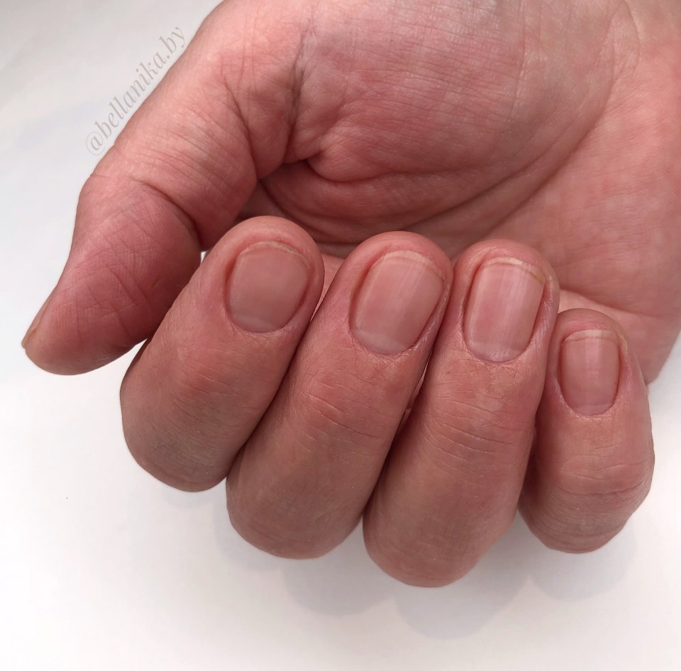 Очень короткие ногти на руках