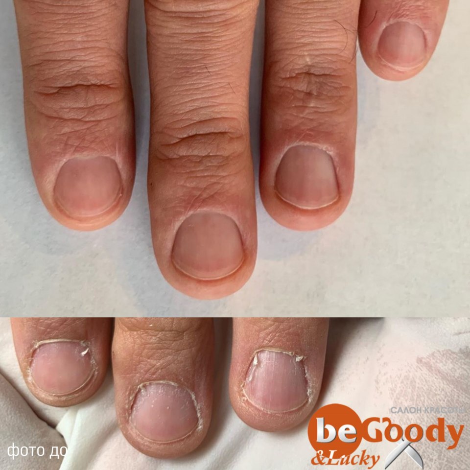 Некрасивые короткие ногти
