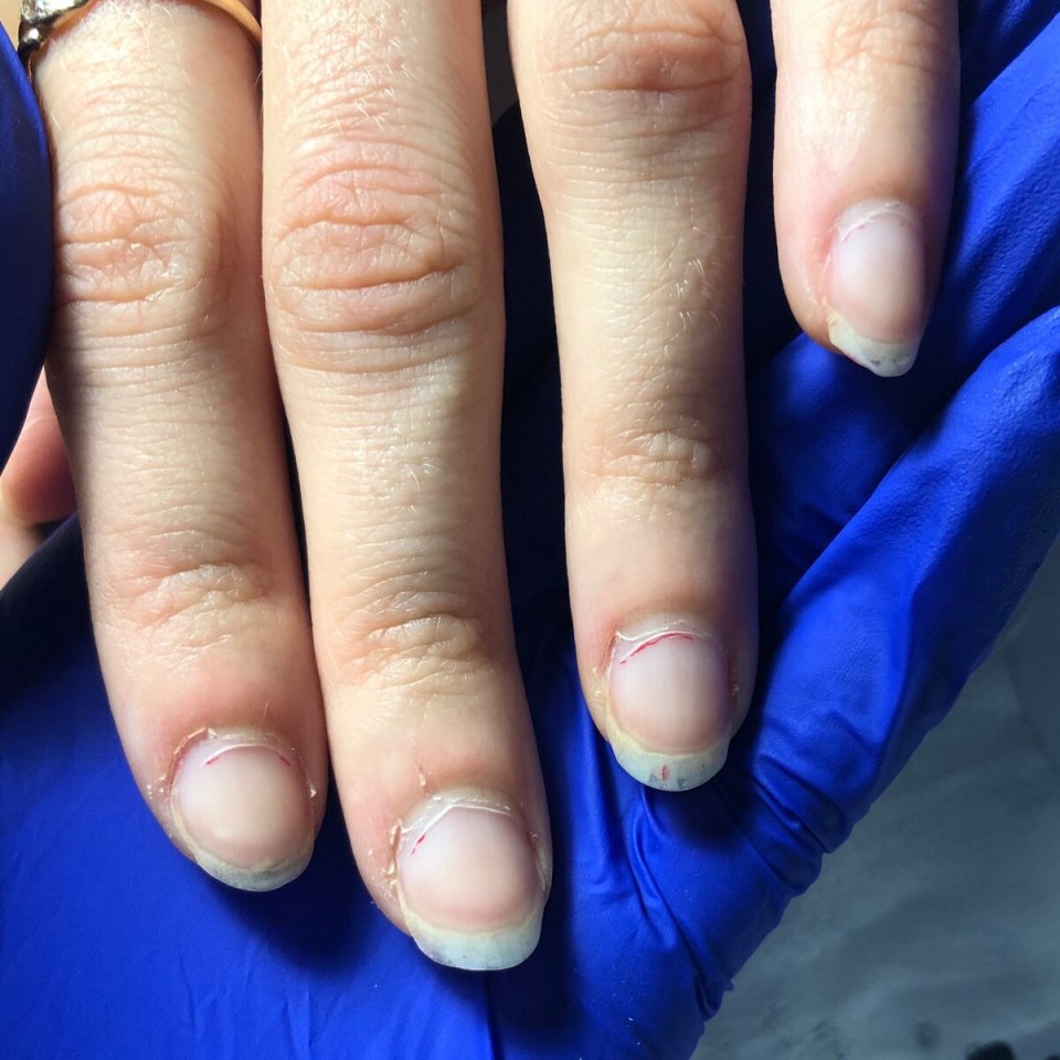 Атрофический акродерматит