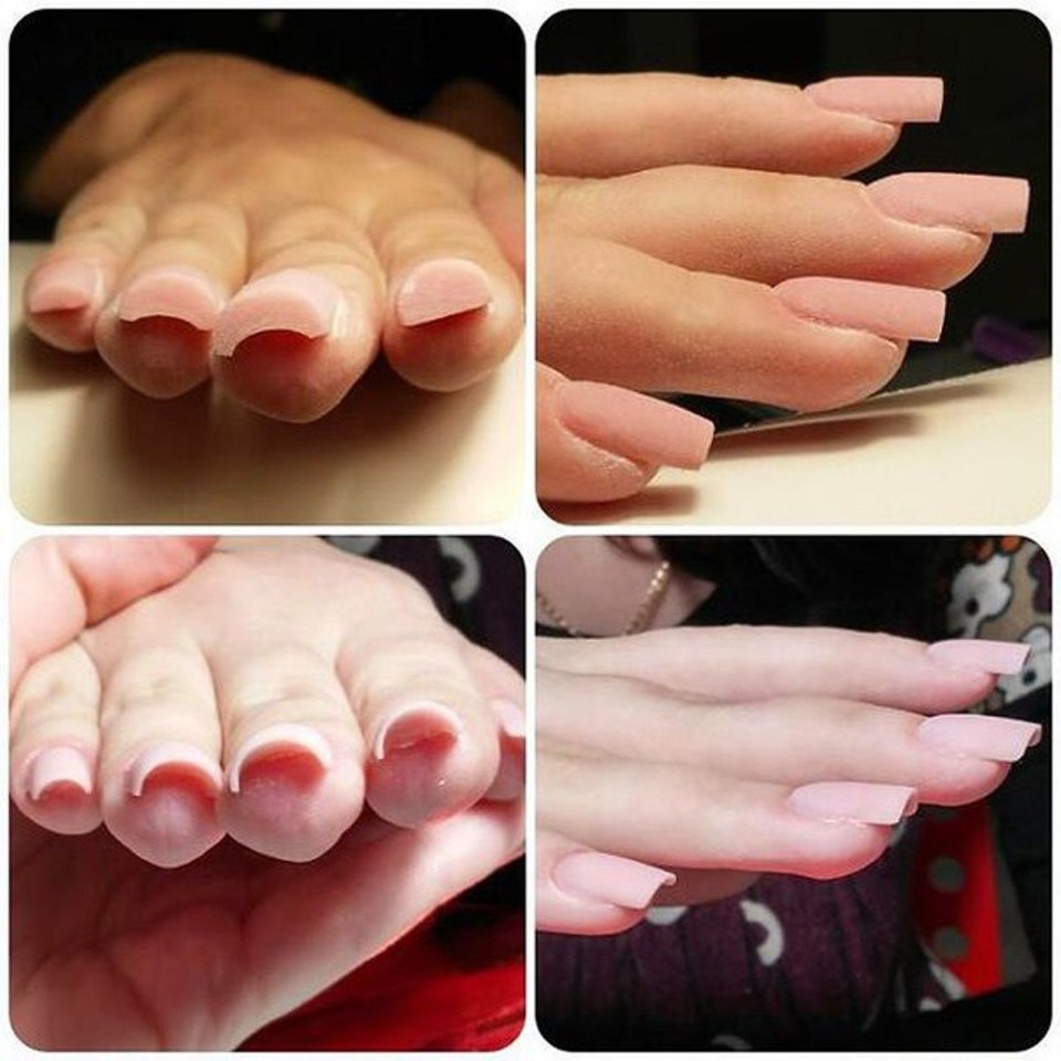 Клюющие ногти