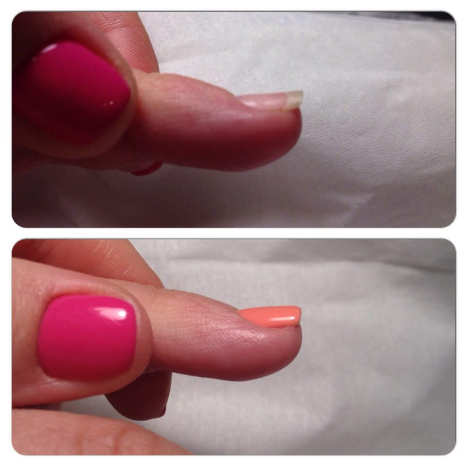 Онихогрифоз ногтевых пластин