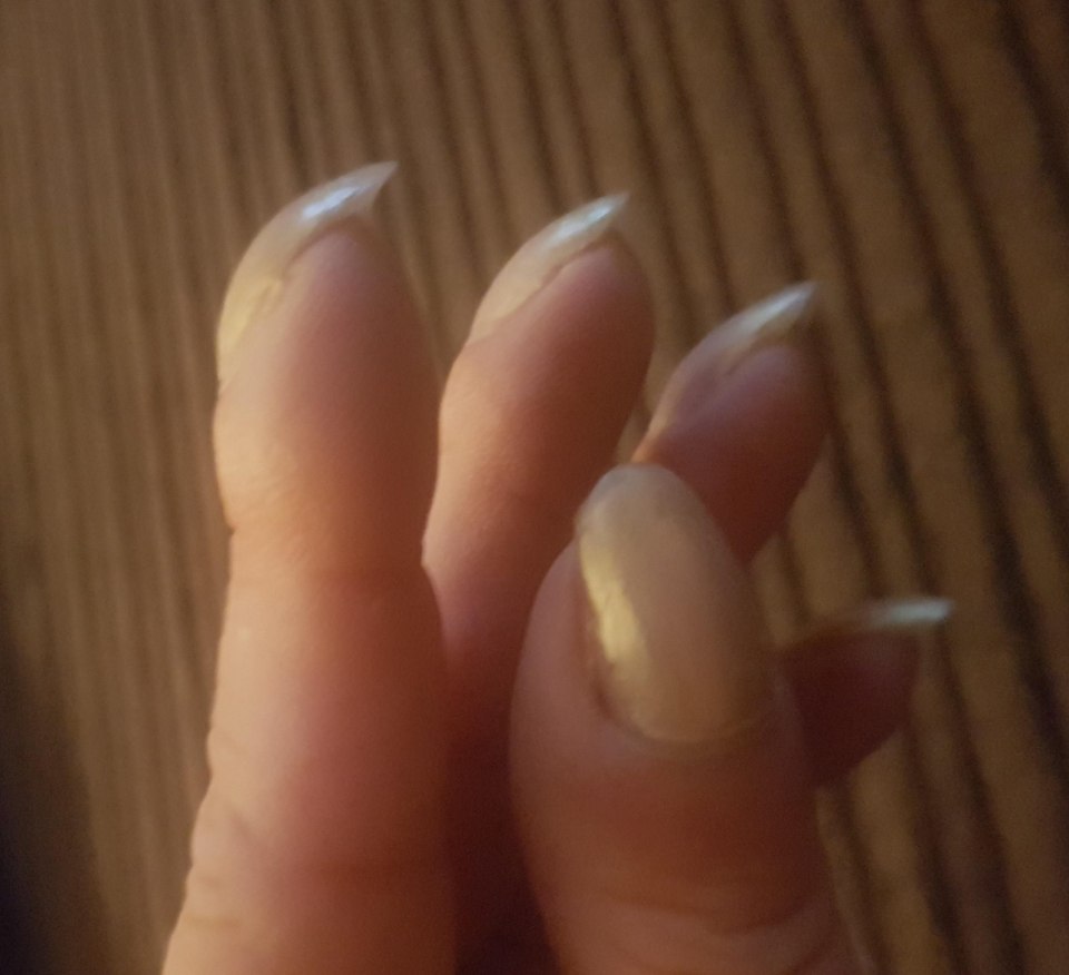 Заболевание ногтя онихогрифоз