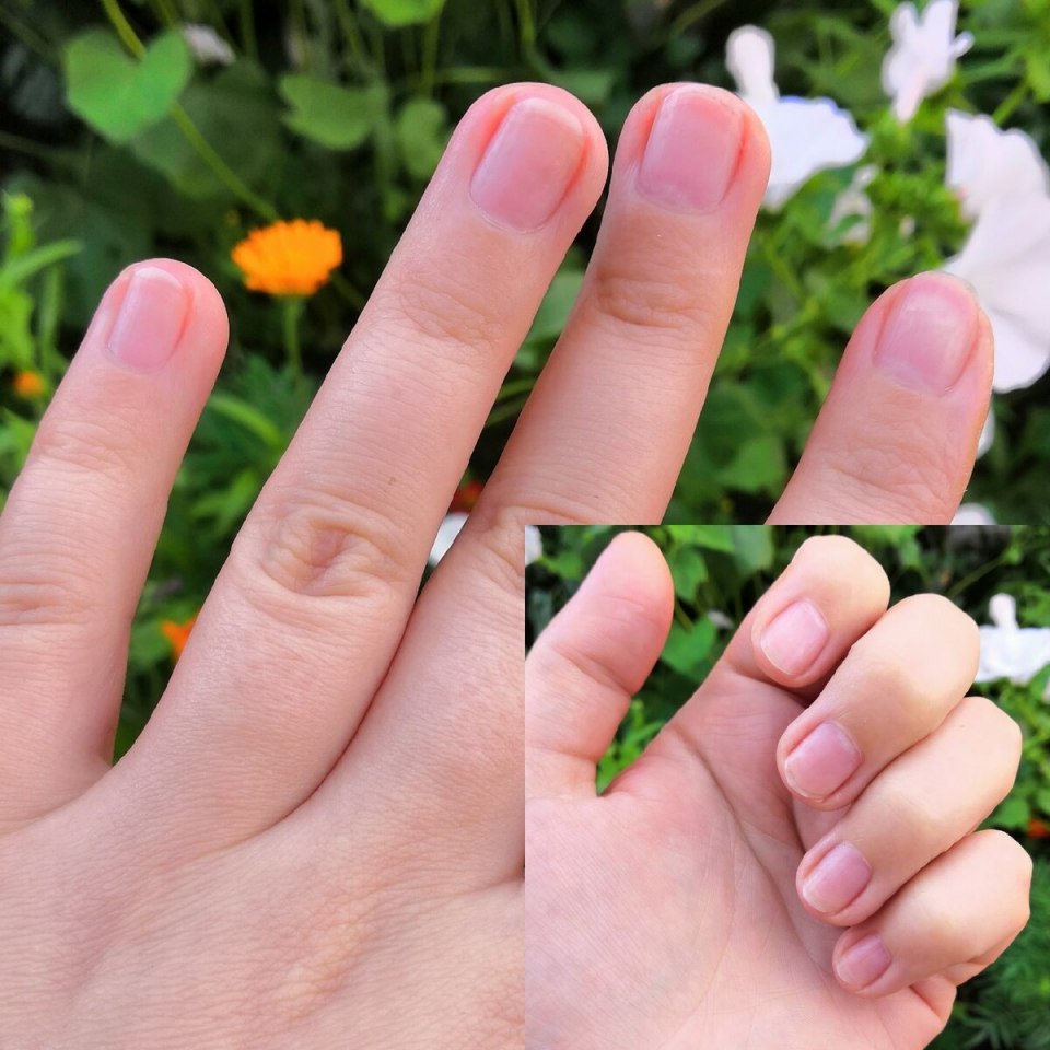 Узкие ногти на руках