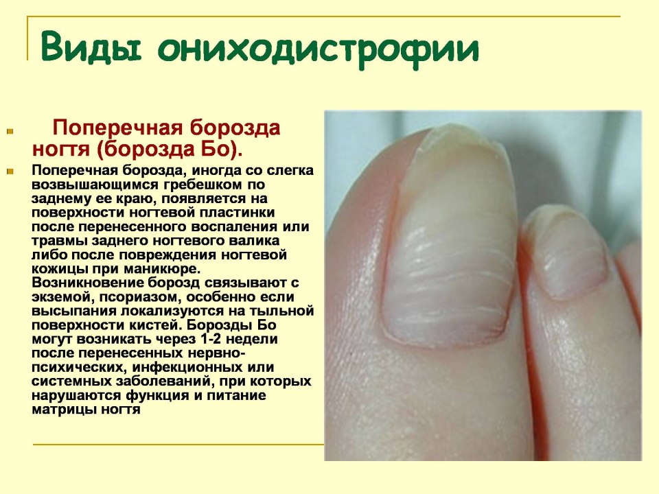 Поперечные борозды на ногтях
