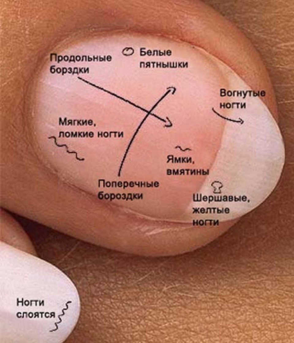 Выявление болезни по ногтям
