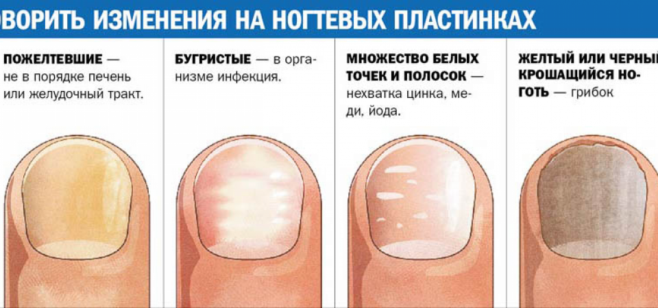 Стадии развития грибка ногтей