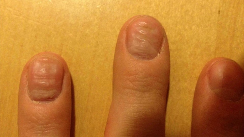 Микотическая лейконихия