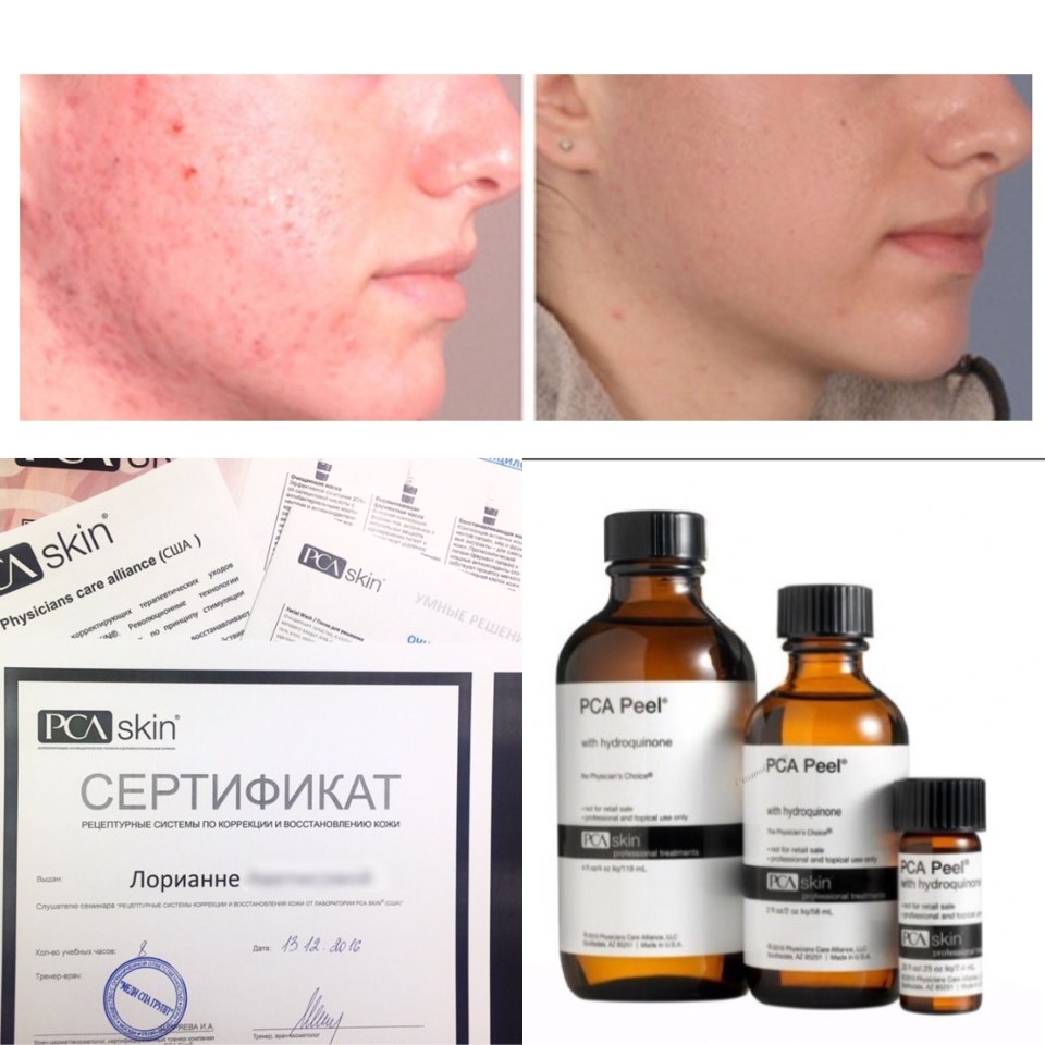 Пилинг Джесснера от акне